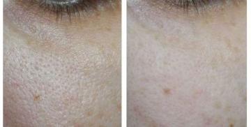 Show and tell how the grout for the pores on the skin 50+